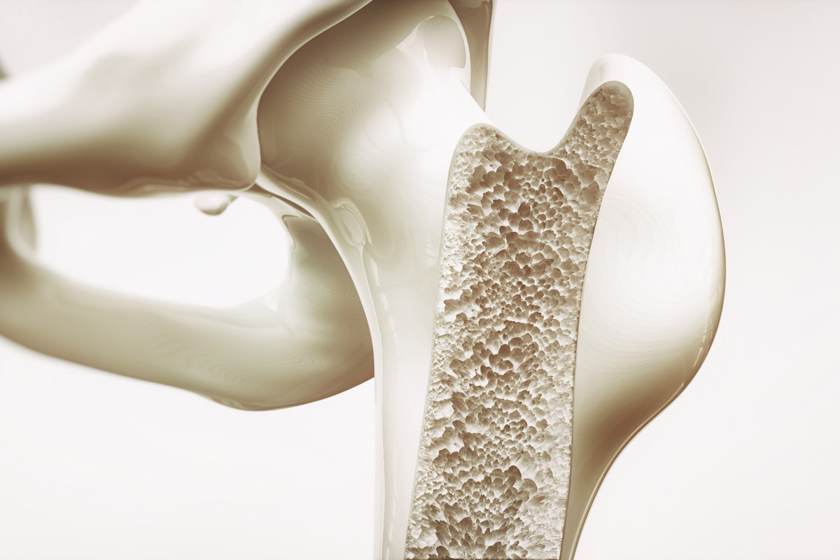3-D image of bone with osteoporosis