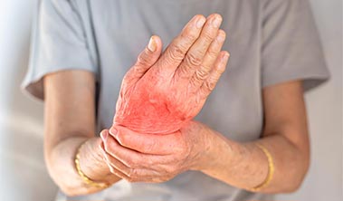 Closeup of person holding their red and inflamed hand.