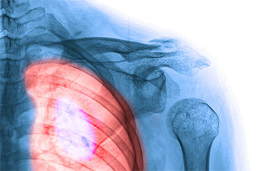 Illustration of medical image, similar to an Xray, showing an inflamed lung.