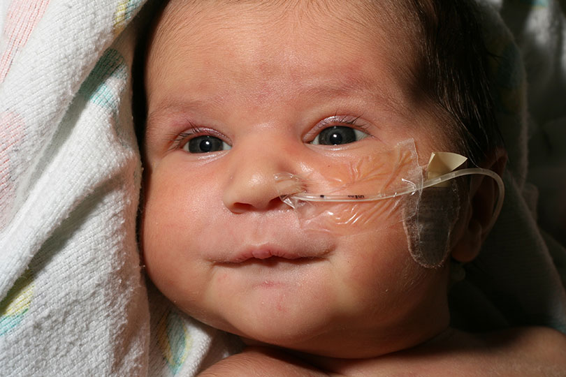 Alert infant with nasal tube.