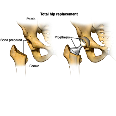 What Happens During Total Hip Replacement? - Magnolia Regional Health Center